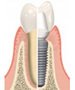Single Tooth Dental Implant