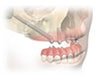 2 Zygoma™ + 2 Dental Implants