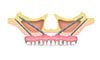 4 Zygoma™ Implants