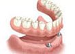 2 Dental Implants 1 Overdenture